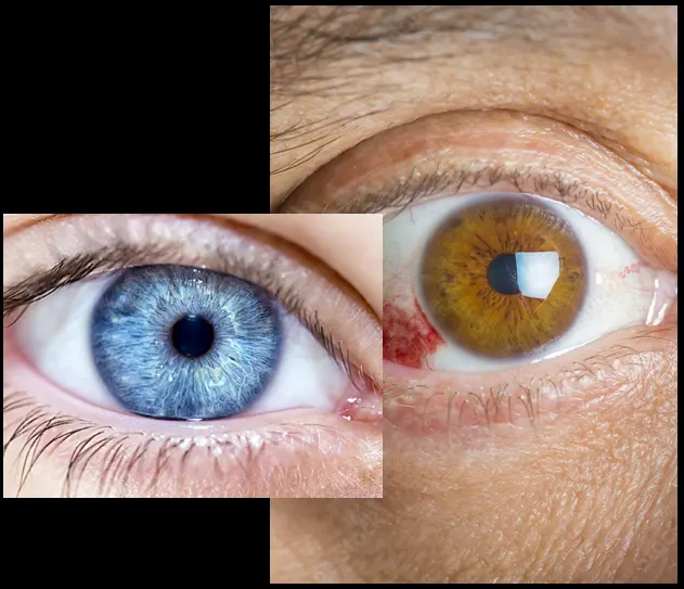 Pathologies de l œil
